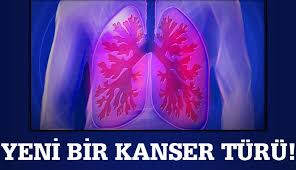Yeni bir akciğer kanseri tipi tespit edildi