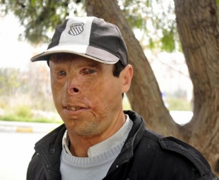 4.Yüz nakli yapılacak 0