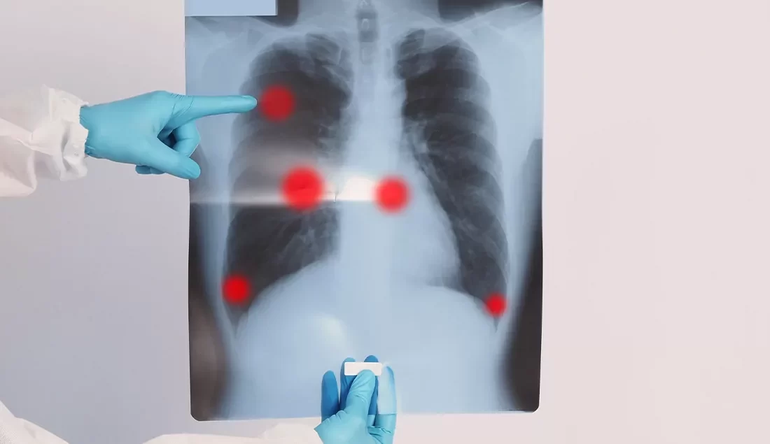 Elektronik Sigara Tehlikesi: EVALI Alarmı! Prof. Dr. Kaan Yılancıoğlu, elektronik sigara (vaping) kullanımına bağlı olarak