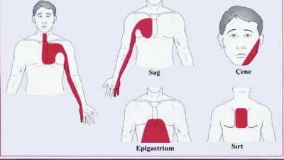 Prof. Dr. Şervan Gökhan, kalp krizinin her zaman tek bir